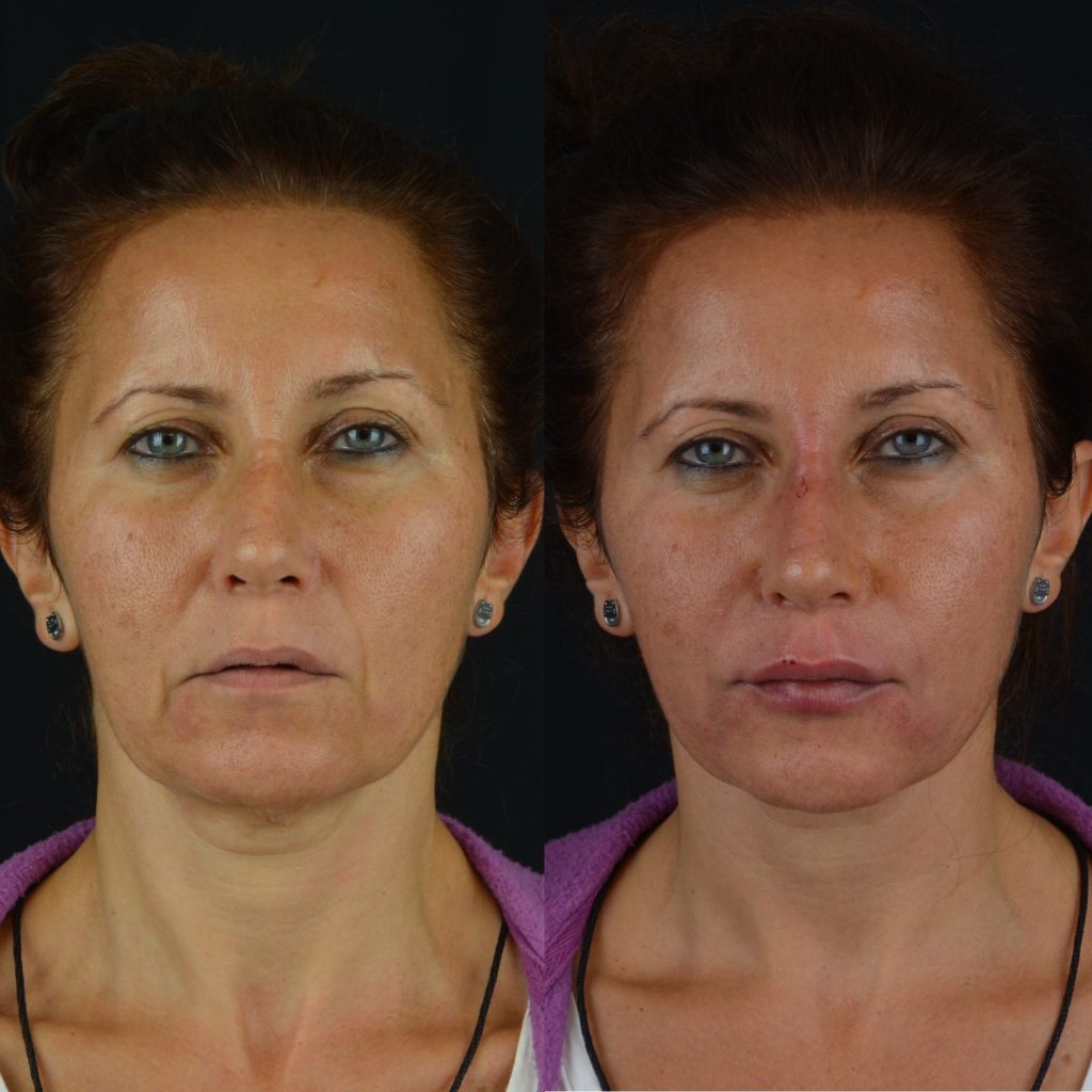 Galeri Nazolabial Dolgu Stanbul Facial Plastic Surgery