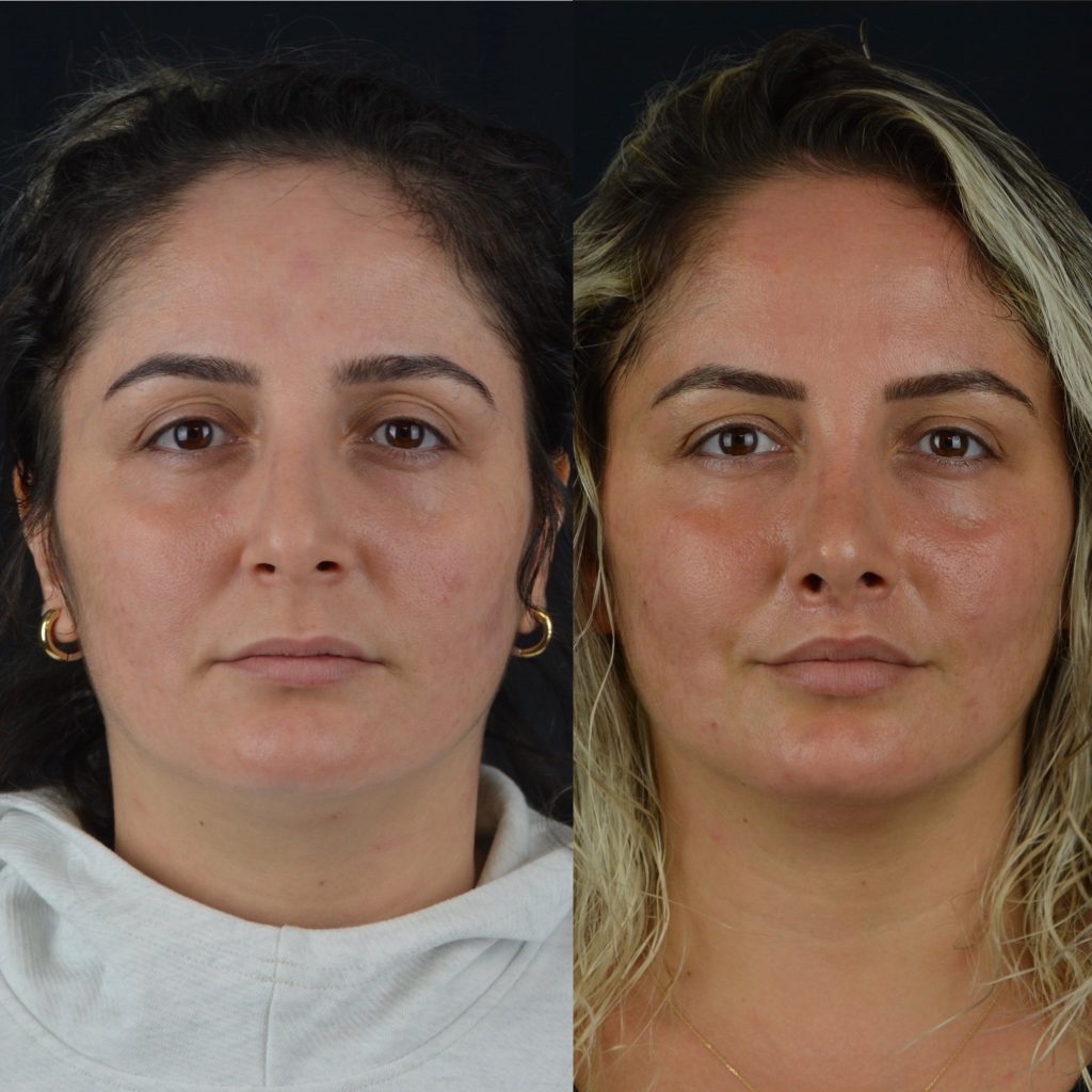 Galeri Dudak Kaldırma İstanbul Facial Plastic Surgery